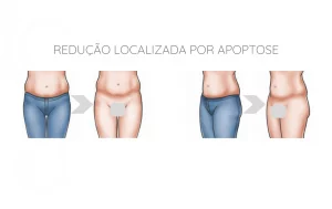 Imagem de ilustração de marca do uso de calça cós baixo que deforma os tecidos de gordura local